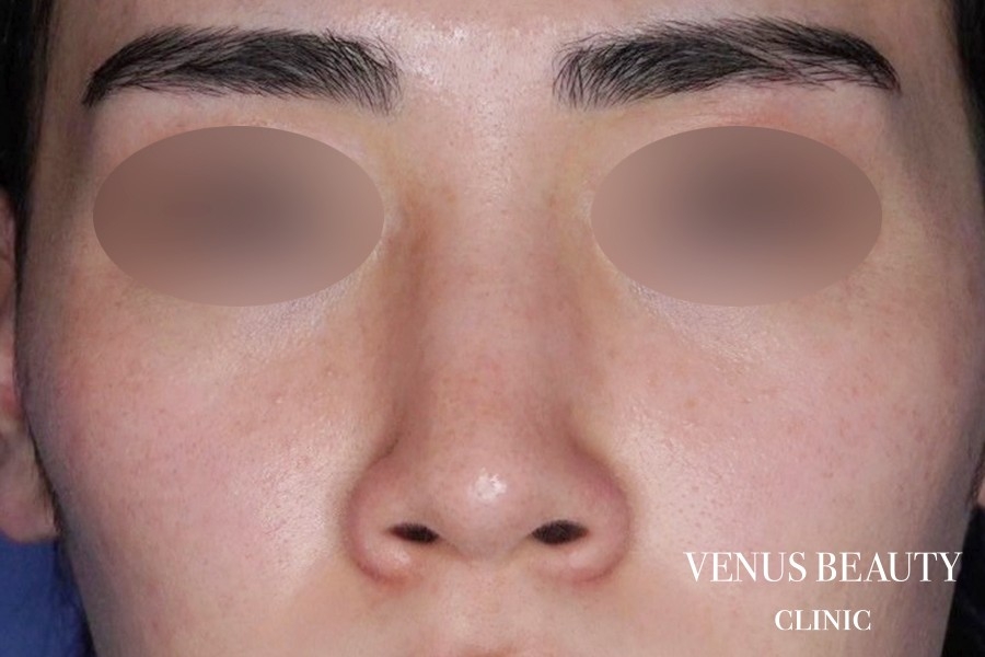 鼻尖形成 施術前