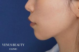 糸リフト+脂肪吸引 施術後