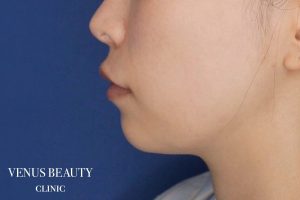 糸リフト+脂肪吸引 施術前