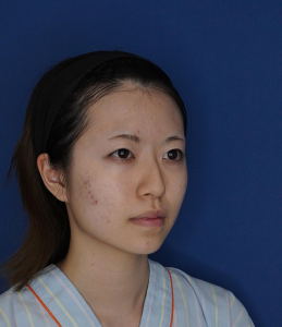 耳介軟骨移植 施術前