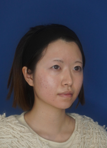 耳介軟骨移植 施術後