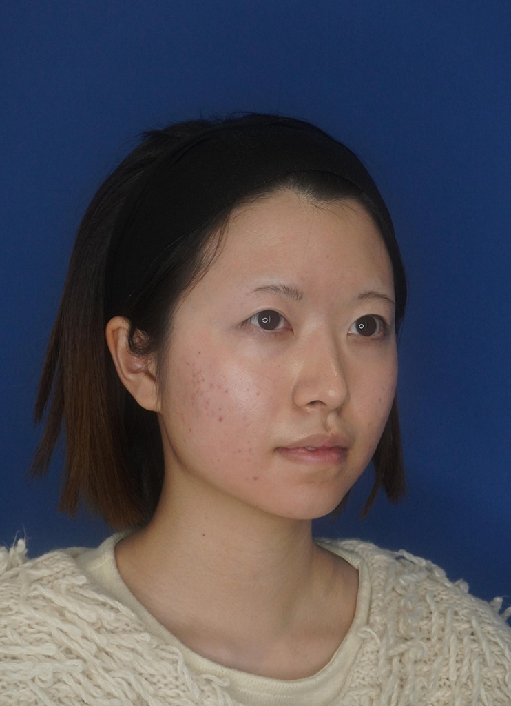 耳介軟骨移植 施術後