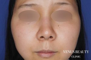 鼻翼縮小 施術前