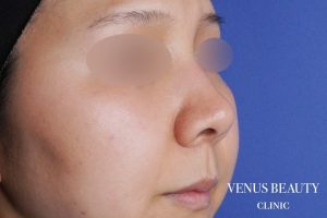 鼻中隔延長 施術前