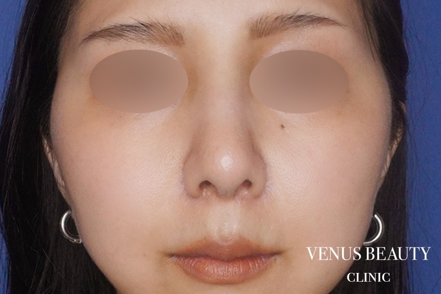 鼻翼縮小 施術後