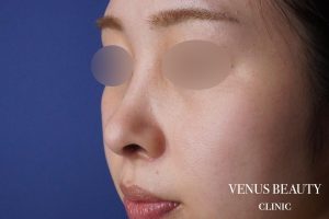 鼻中隔延長 施術後