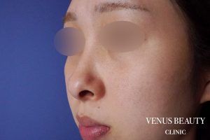 鼻中隔延長 施術前