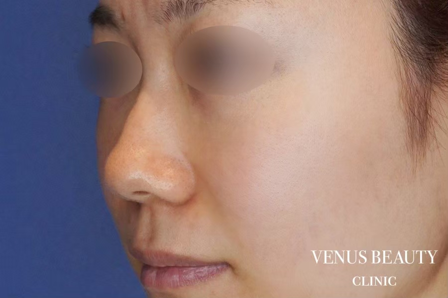 鼻中隔延長 施術前