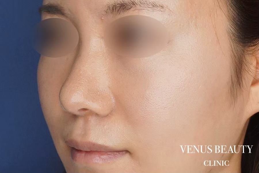 鼻中隔延長 施術後