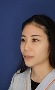 耳介軟骨移植 施術前