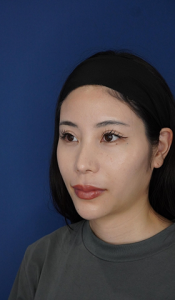 耳介軟骨移植 施術後