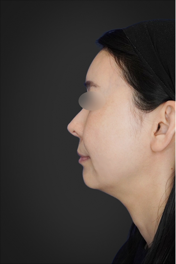 耳介軟骨移植 施術後