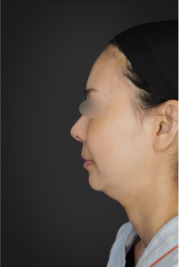 耳介軟骨移植 施術前