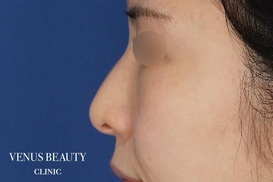 わし鼻・段鼻修正 ハンプ切除 施術前