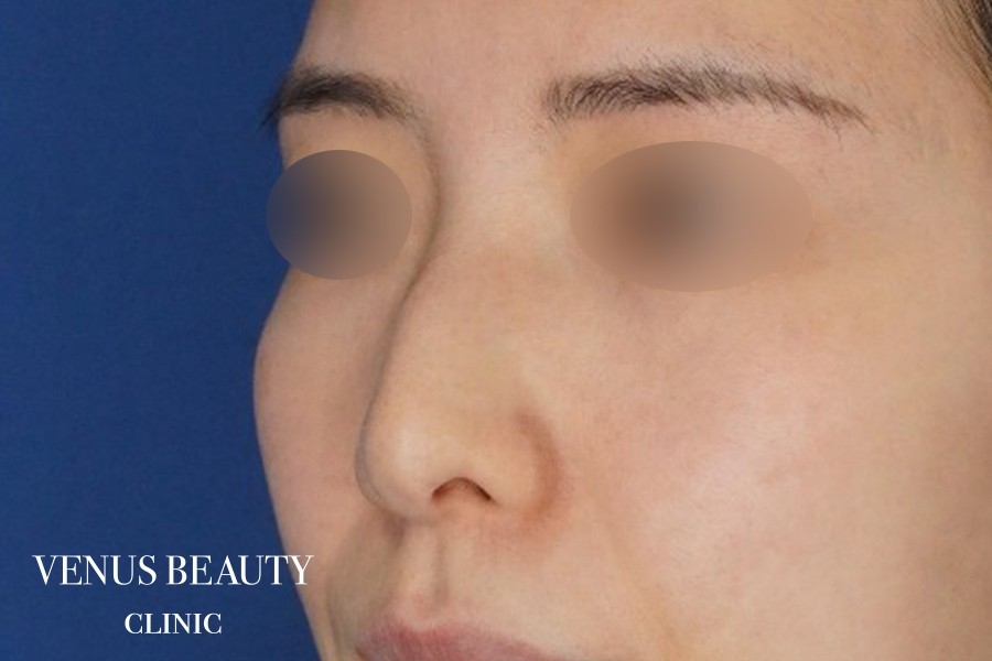 わし鼻・段鼻修正 ハンプ切除 施術前