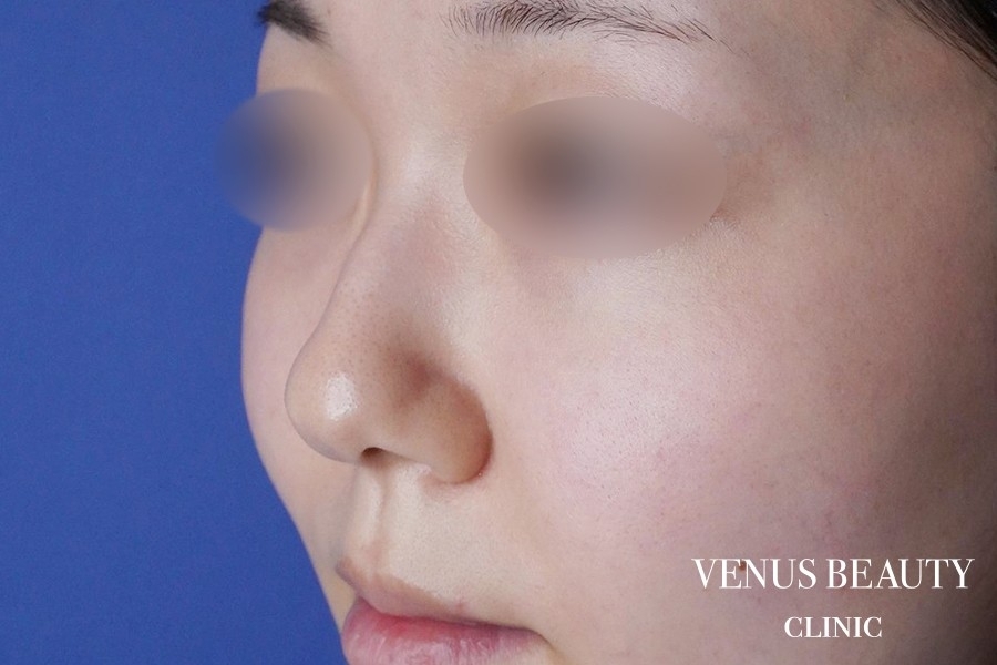 鼻尖形成 施術前