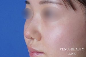 鼻翼縮小 施術後