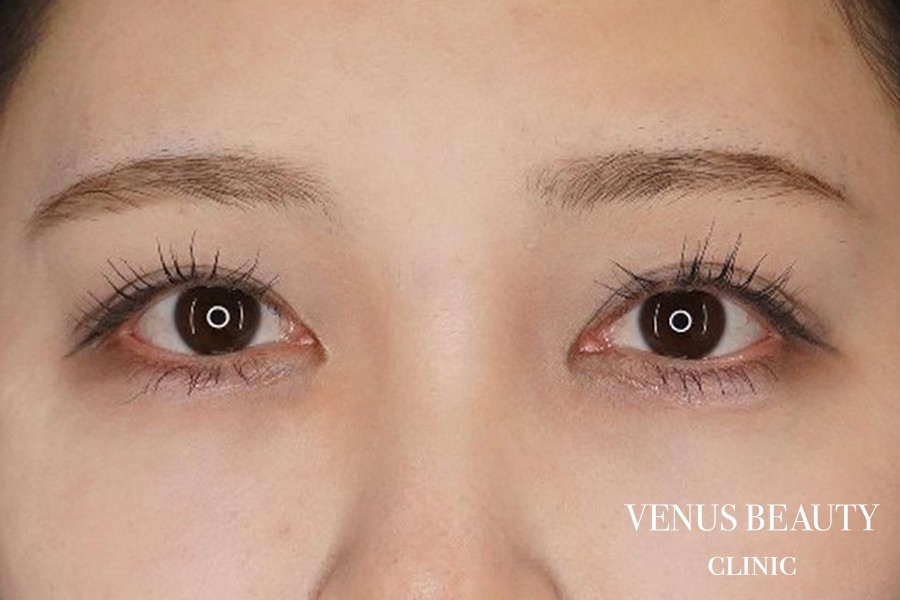 目頭切開 施術後