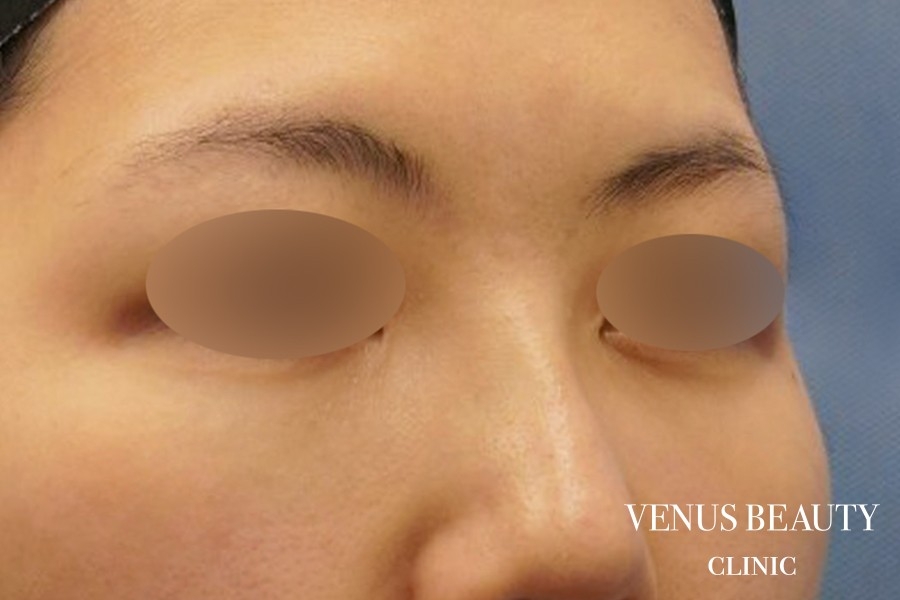 下まぶたのたるみとり 施術後