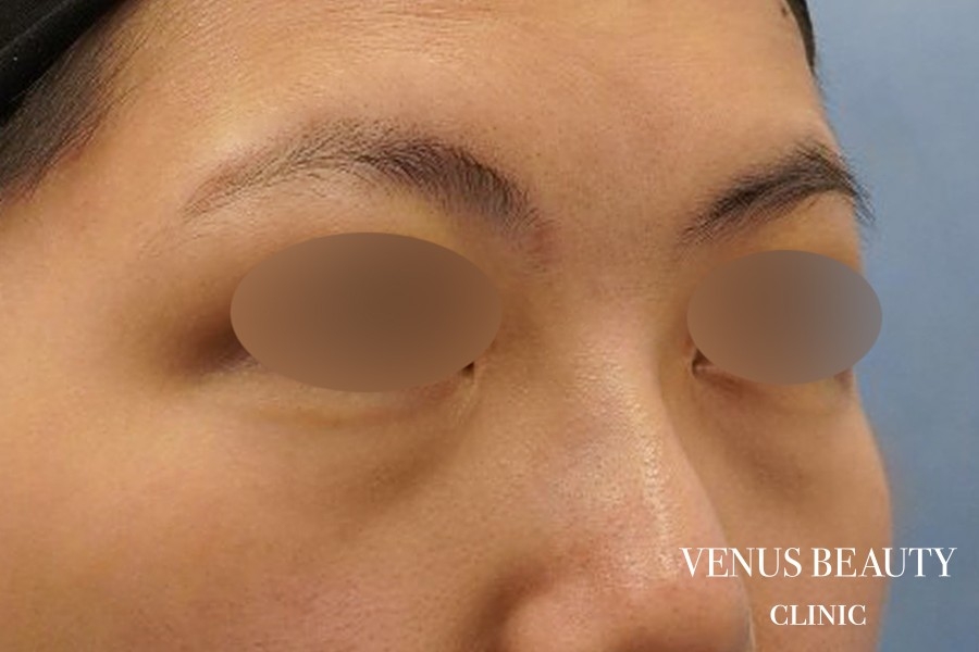 下まぶたのたるみとり 施術前