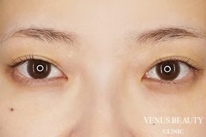 二重まぶた埋没法 施術後