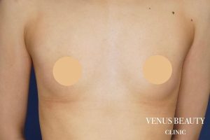 脂肪注入豊胸 施術前