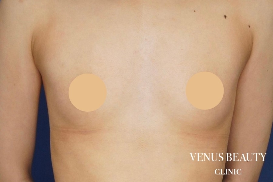 脂肪注入豊胸 施術前