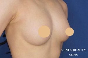 脂肪注入豊胸 施術後