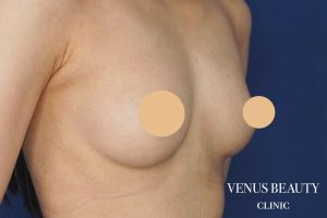 脂肪注入豊胸 施術前