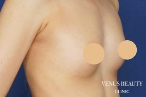 脂肪注入豊胸 施術後