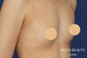 脂肪注入豊胸 施術前