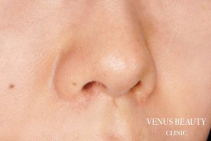 傷跡修正 施術後