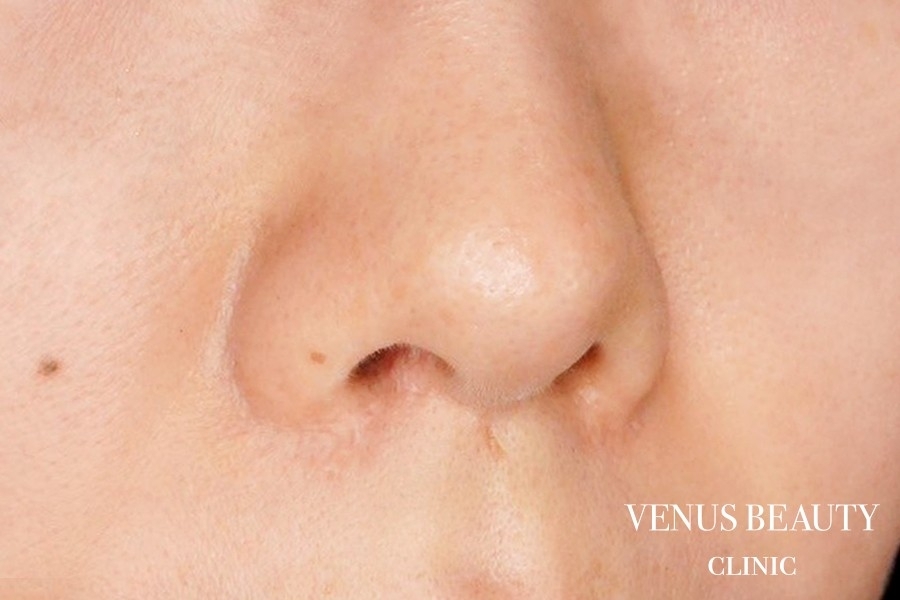 傷跡修正 施術後