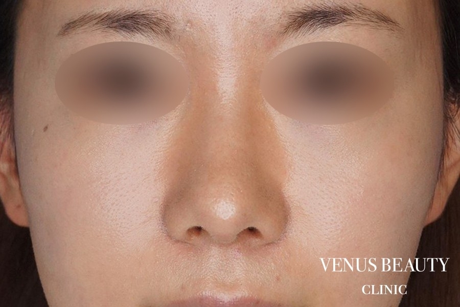 鼻尖形成 施術後