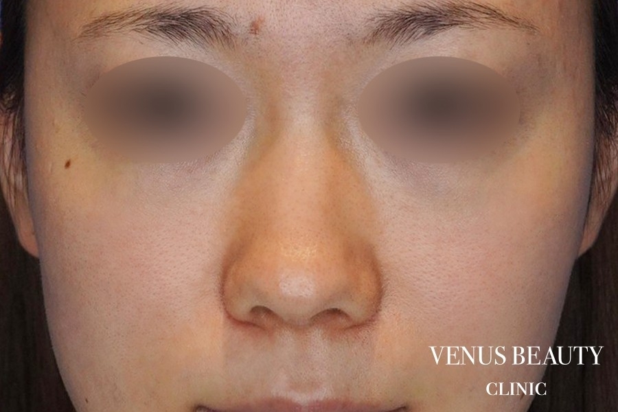 鼻尖形成 施術前