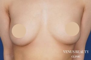 脂肪注入豊胸 施術後