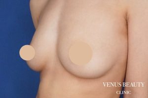 脂肪注入豊胸 施術後