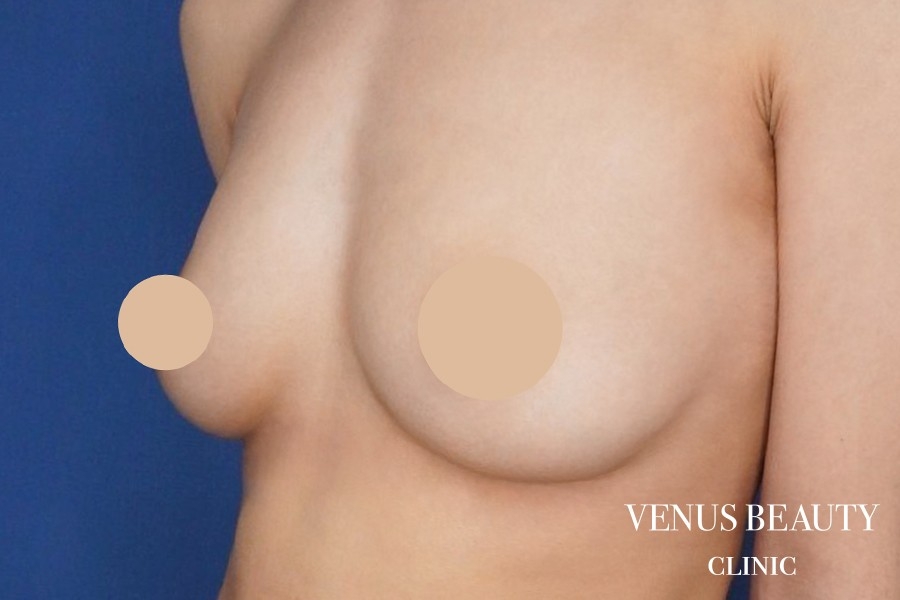 脂肪注入豊胸 施術後