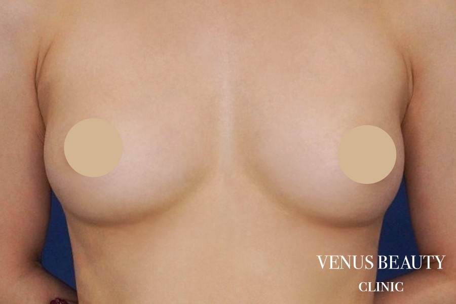 脂肪注入豊胸 施術後