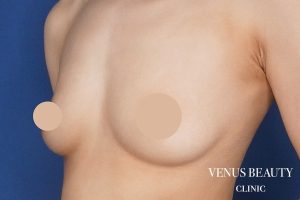 脂肪注入豊胸 施術前