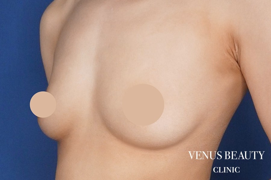 脂肪注入豊胸 施術前