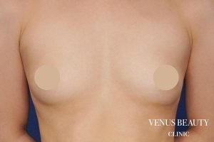 脂肪注入豊胸 施術前