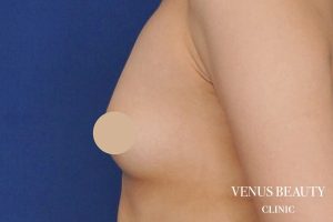 脂肪注入豊胸 施術前