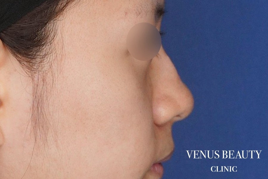 耳介軟骨移植 施術前