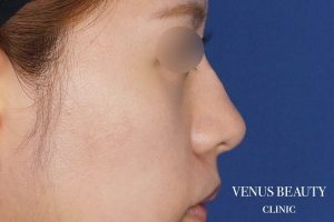 耳介軟骨移植 施術後