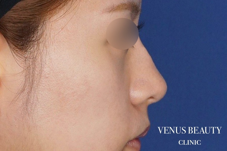 耳介軟骨移植 施術後