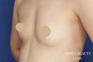 脂肪注入豊胸 施術前