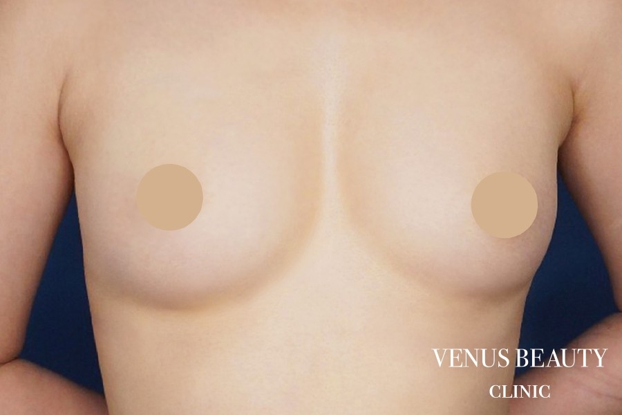 脂肪注入豊胸 施術後