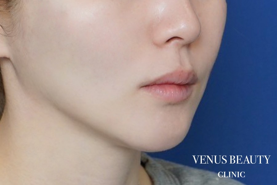 ダブロゴールド 施術後