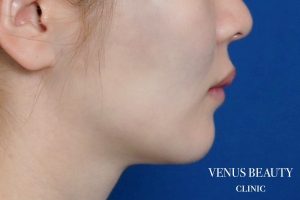 ダブロゴールド 施術前